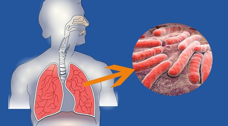 Туберкулезная интоксикация - кто в группе риска и как возникает