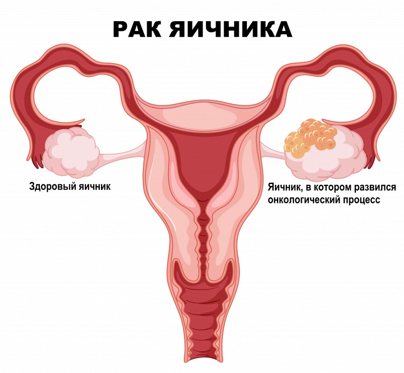 лечение рака яичников