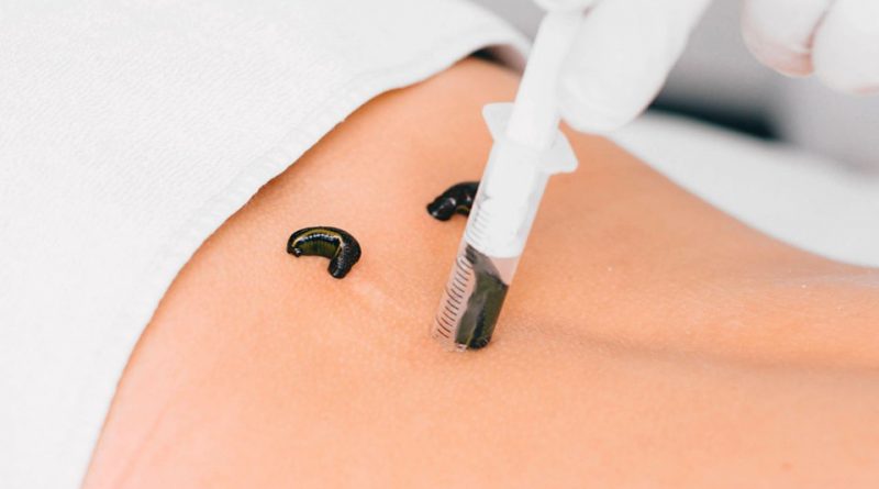 Как используют пиявки медицинские и где возможно заказать онлайн